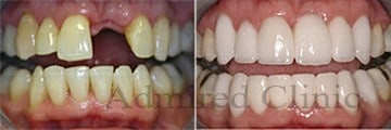 Single dental implant at Admred clinic