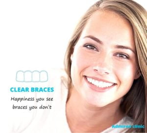 Orthodontics treatment using Clear braces by Admired clinic dentist in Clacton on sea