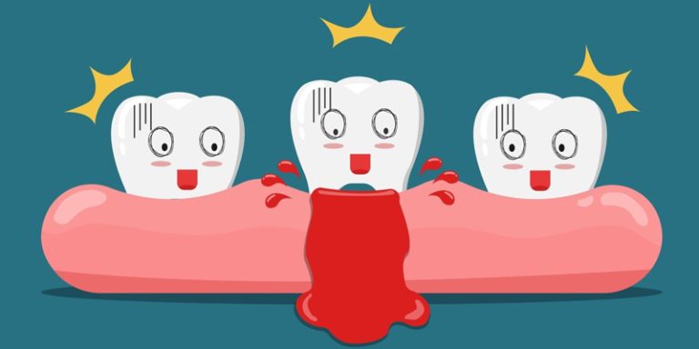 Bleeding Gums? How It Happened and What to Do Next