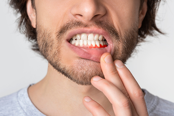 Bleeding Gums