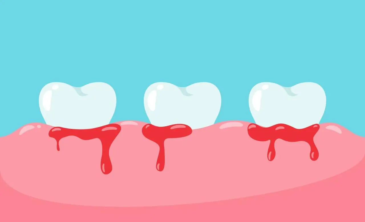 Bleeding Gums