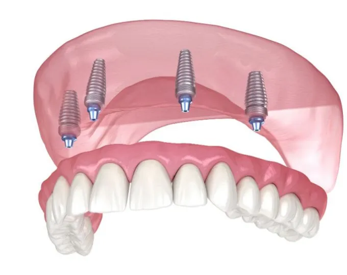 Full Arch dental implant offered at Admired clinic clacton on sea