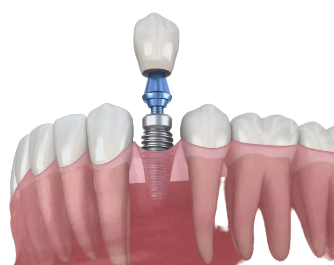 Single dental implant offered by Admired clinic in Clacton on Sea