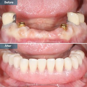 implant supported denture