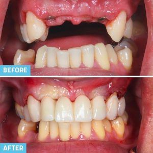 Implant Bridge Treatment