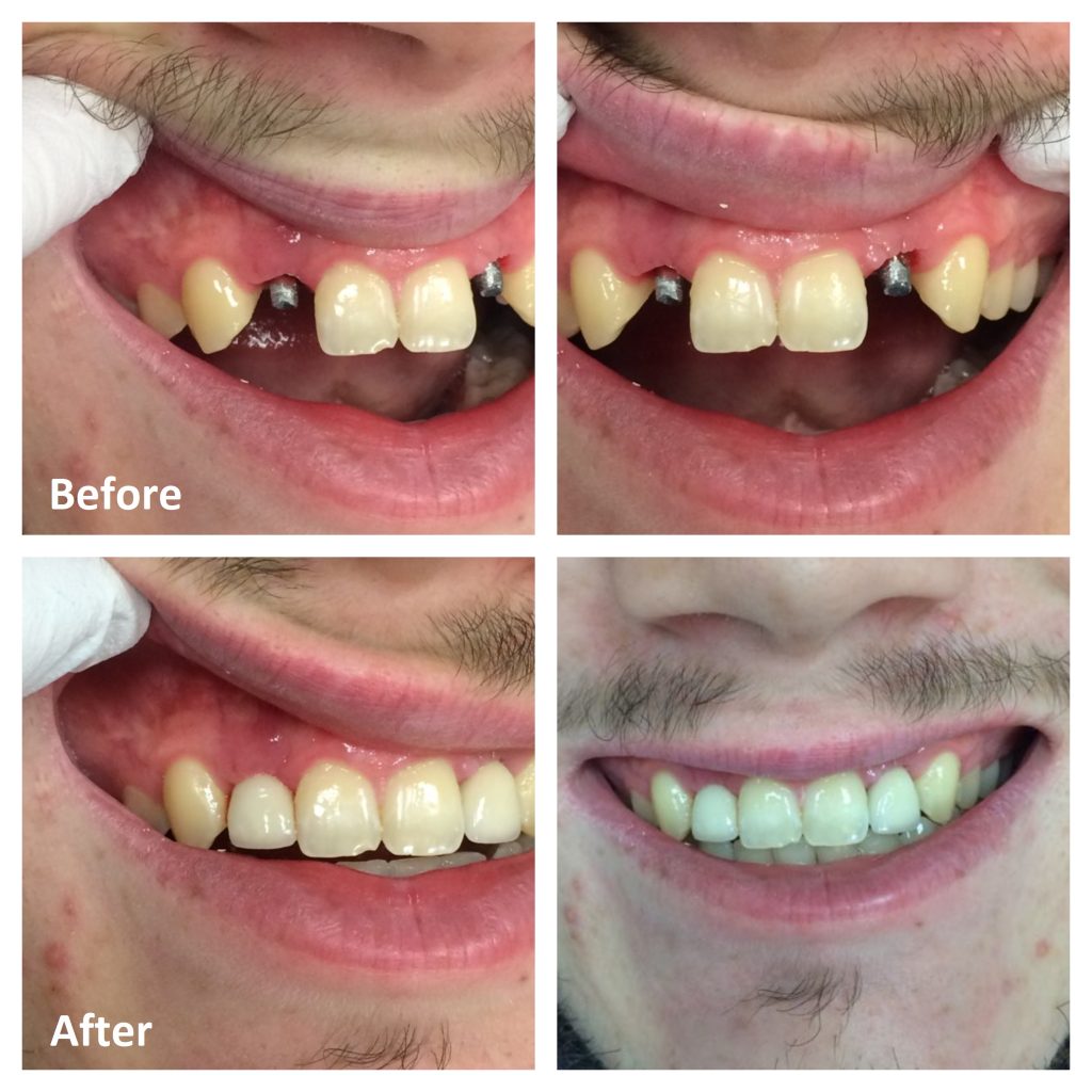 single dental implant