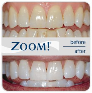 zoom Philips teeth whitening