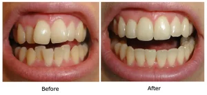 invisalign