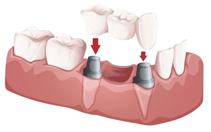 Dental bridges in clacton