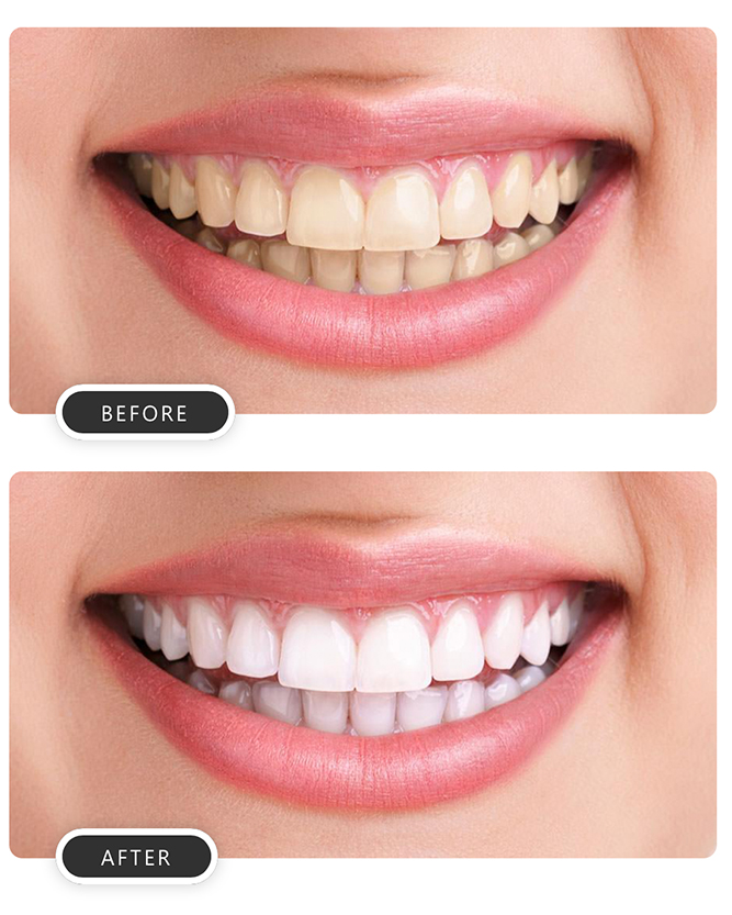 Teeth whitening in Clacton