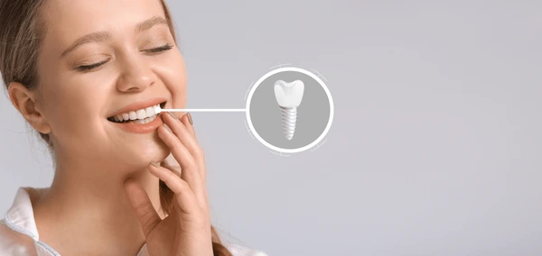 dental implants