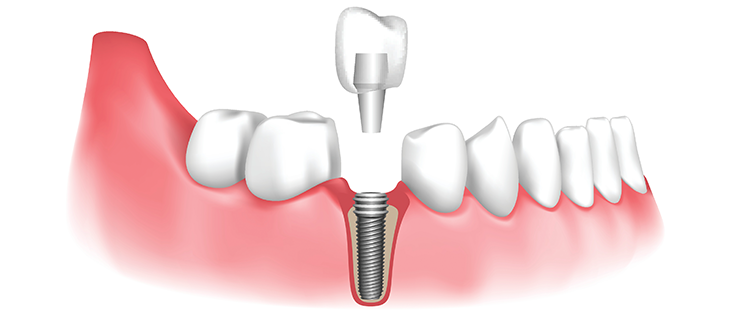 Dental implants