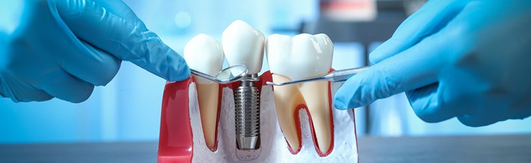 Dental implants