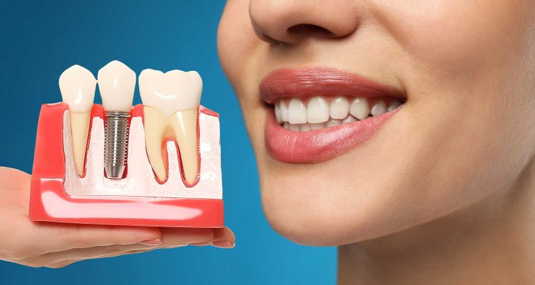 Dental implants