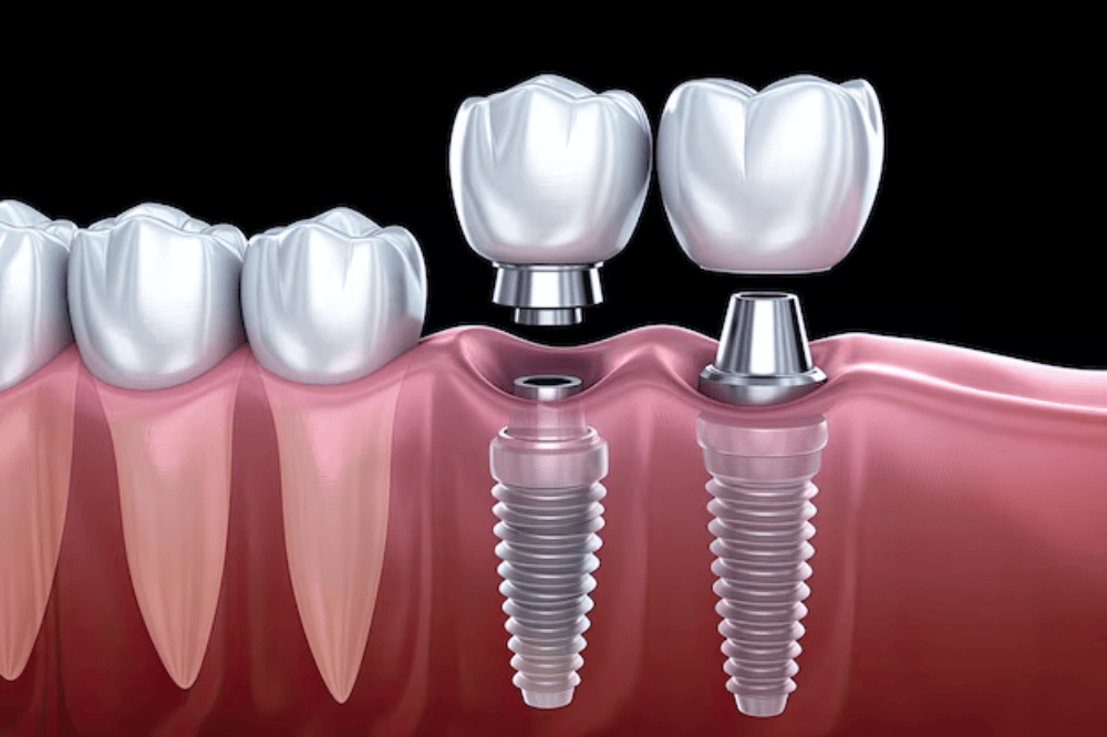 Dental implants