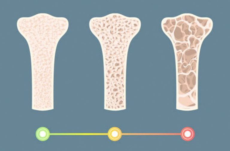 Best Dental Implants Solutions for Patients with Low Bone Density