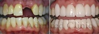 Dental implants & Veneers