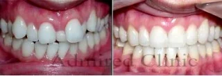Orthodontics Clacton On sea before and after Admired clinic